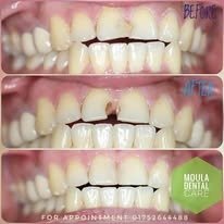 Dental Implant Surgery